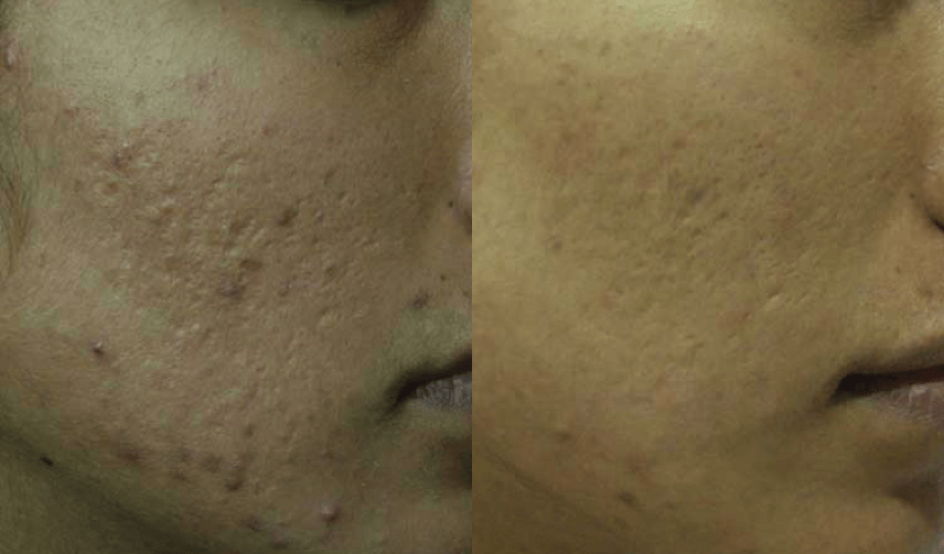résutlats du micro-needling sur cicatrices d'acné