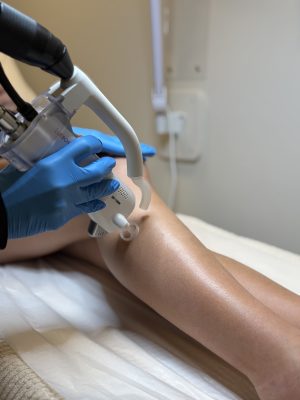 Épilation au laser - Interfessier